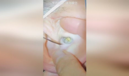 可视采耳视频,可视采耳，耳道清洁新体验